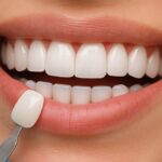 Veneers