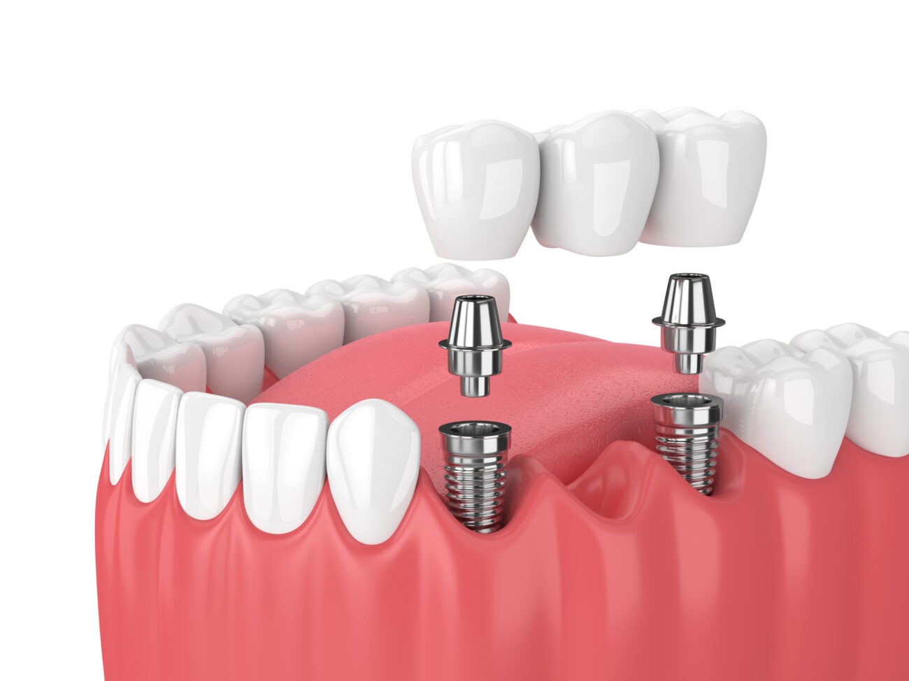 Implants in Agoura Hills