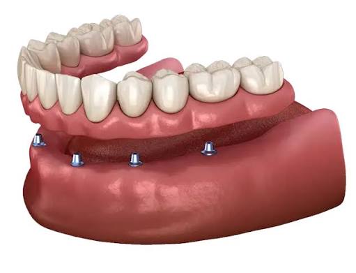 Permanent dentures implants