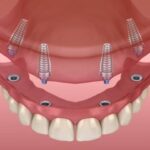 Snap-in dentures Palmdale