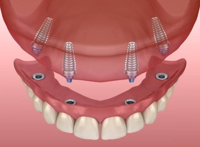 Can Snap-In Dentures in Palmdale Improve Eating and Speaking?
