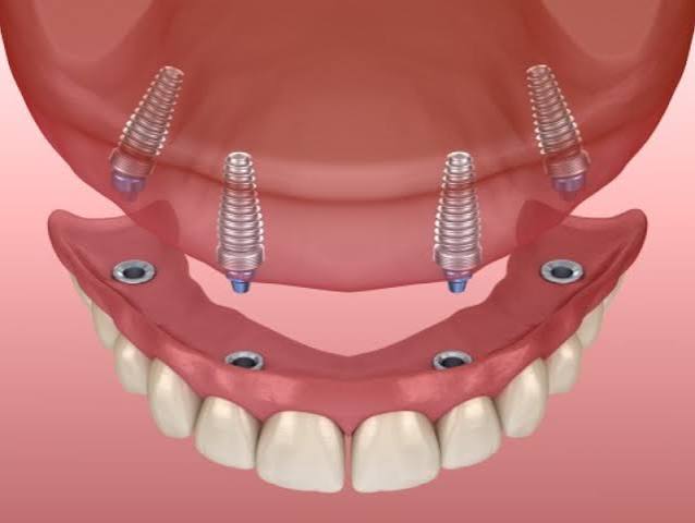 Can Snap-In Dentures in Palmdale Improve Eating and Speaking?